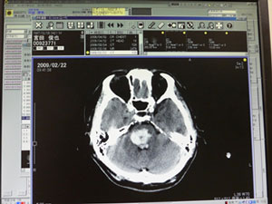 倒れた時の脳幹出血のCT画像。真ん中あたりが脳幹で、白い色の部分が出血。非常に重篤な状態だった。